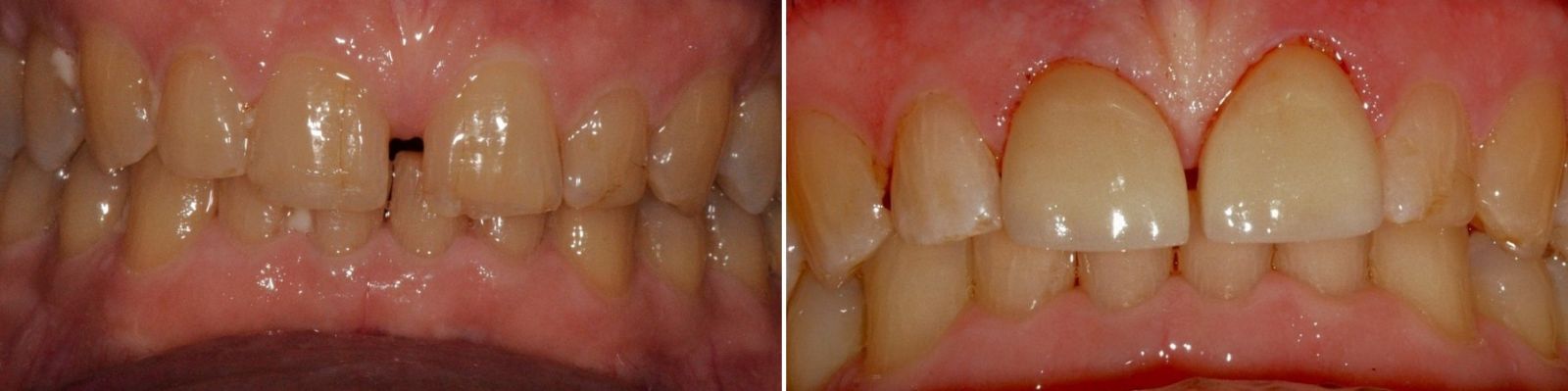 Before & After | Tacoma WA | Dentistry NW